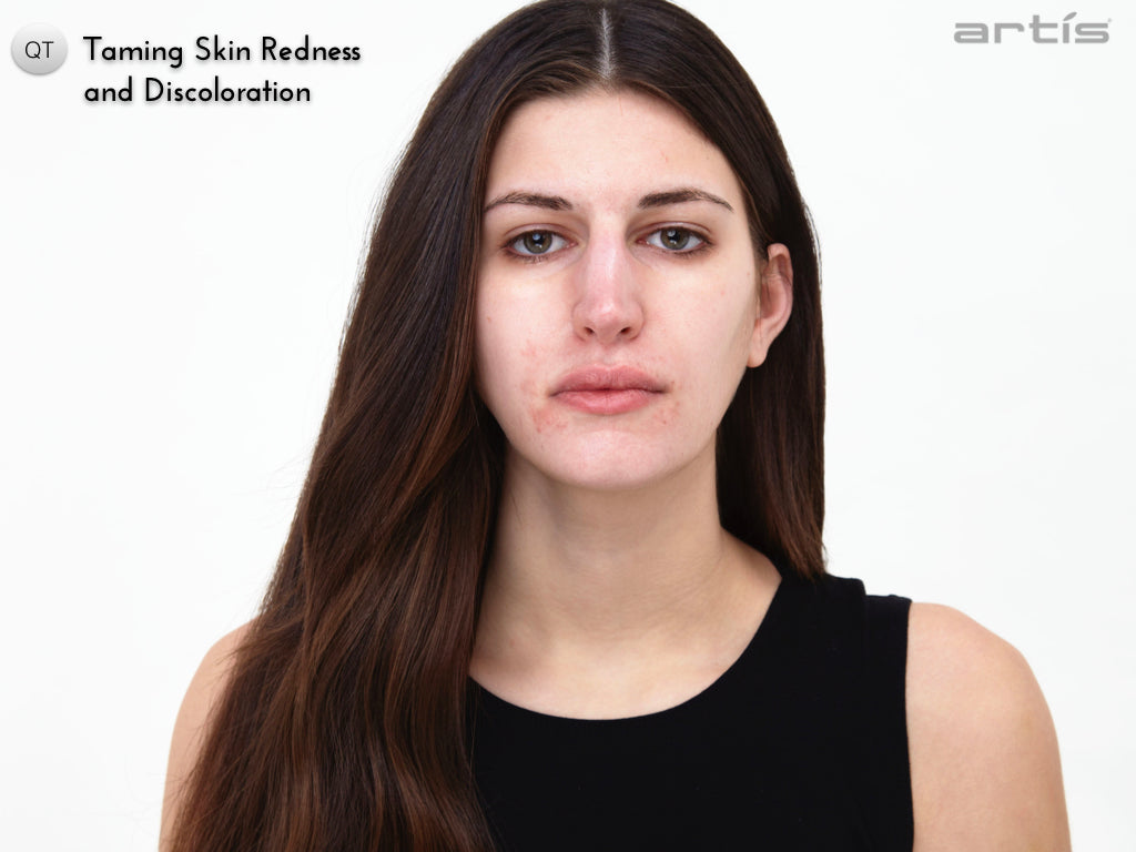 Taming Skin Redness and Discolouration